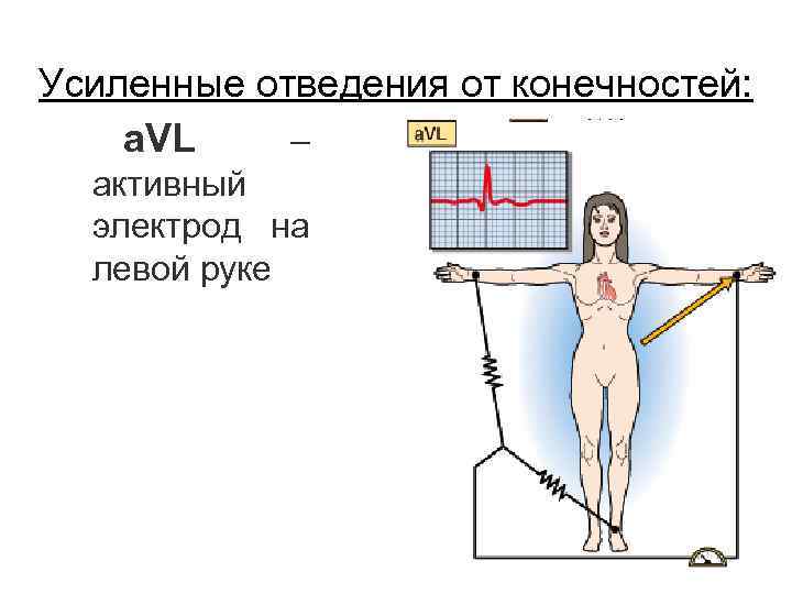 Усиленные отведения от конечностей: a. VL – активный электрод на левой руке 