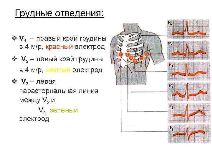 Фиксация электродов в грудных отведениях. Левые и правые грудные отведения на ЭКГ. Правые грудные отведения норма. Правые грудные отведения