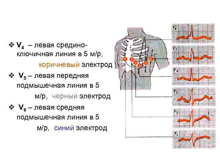 v V 4 – левая срединоключичная линия в 5 м/р, коричневый электрод v V