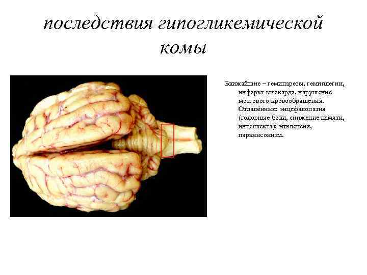 Признаки сахарной комы. Последствия гипогликемической комы. Осложнения гипогликемической комы. Последствия гипогликемической комы для мозга. Гипоглик кома осложнение.