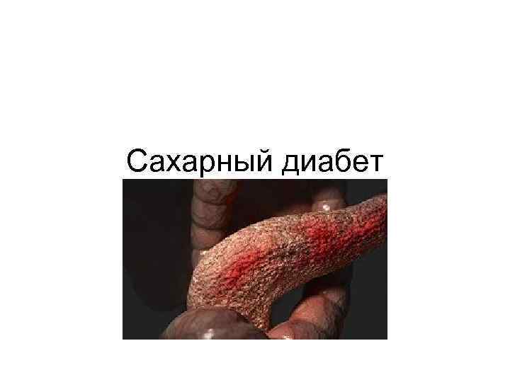 Сахарный диабет 