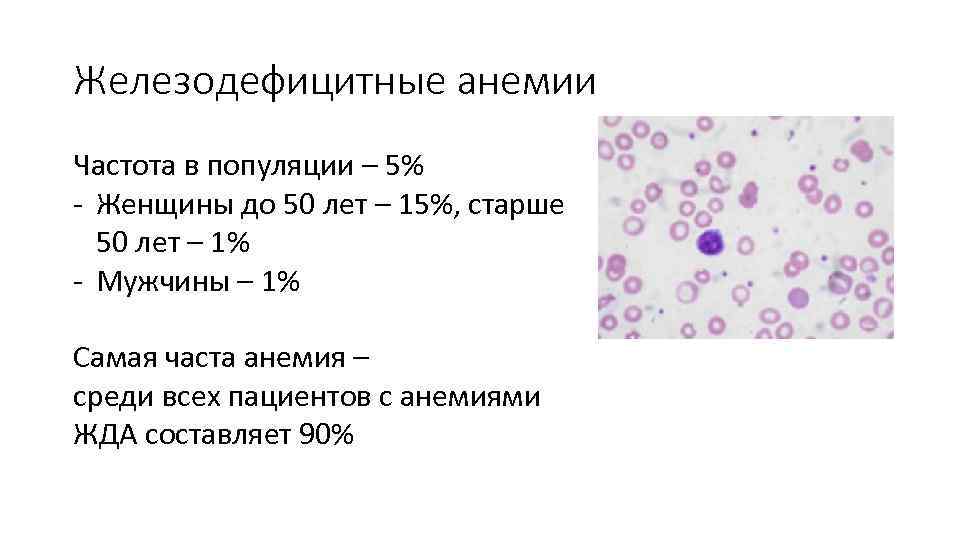 Железодефицитные анемии Частота в популяции – 5% - Женщины до 50 лет – 15%,