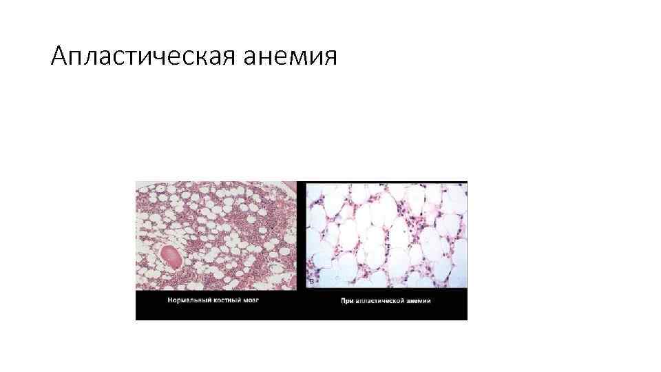 Апластическая анемия 