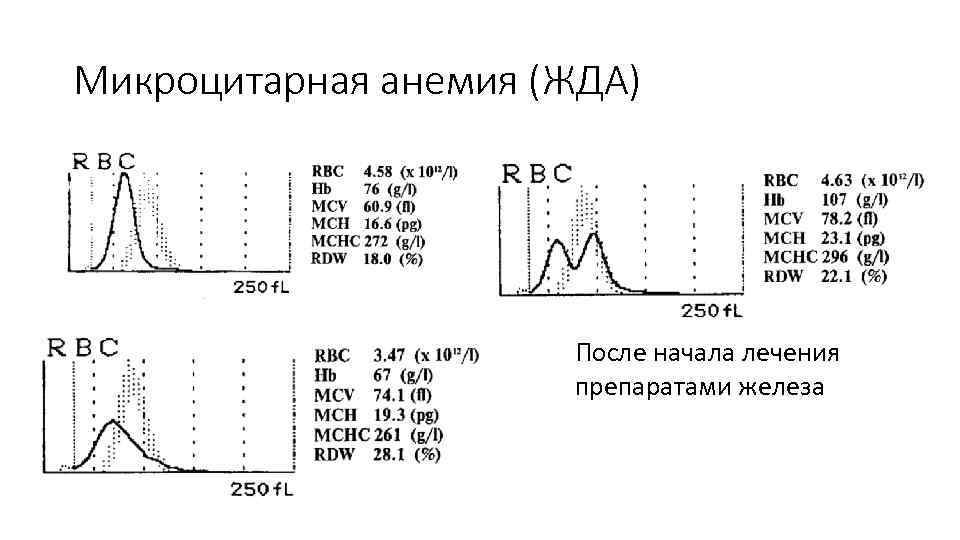Микроцитарная анемия (ЖДА) После начала лечения препаратами железа 