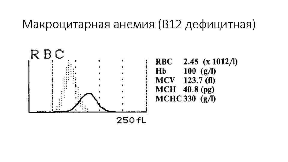 Макроцитарная анемия (В 12 дефицитная) 