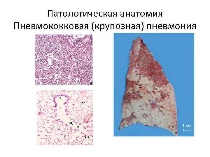 Патологическая анатомия Пневмококковая (крупозная) пневмония 