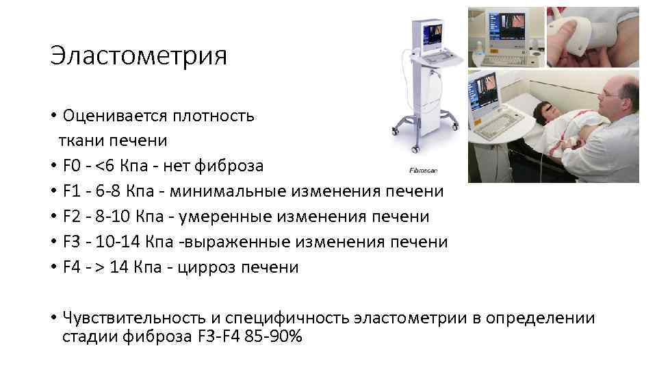 Эластометрия • Оценивается плотность ткани печени • F 0 - <6 Кпа - нет