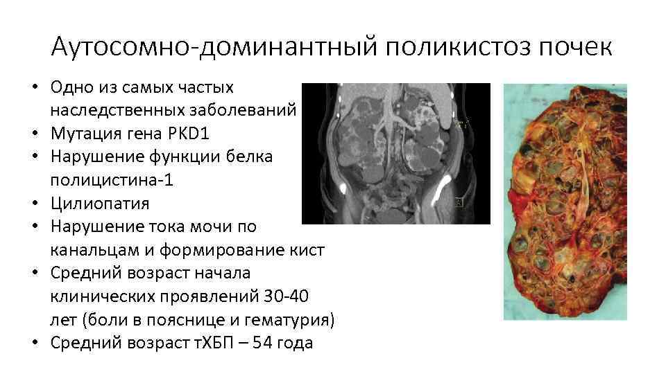 Аутосомно-доминантный поликистоз почек • Одно из самых частых наследственных заболеваний • Мутация гена PKD