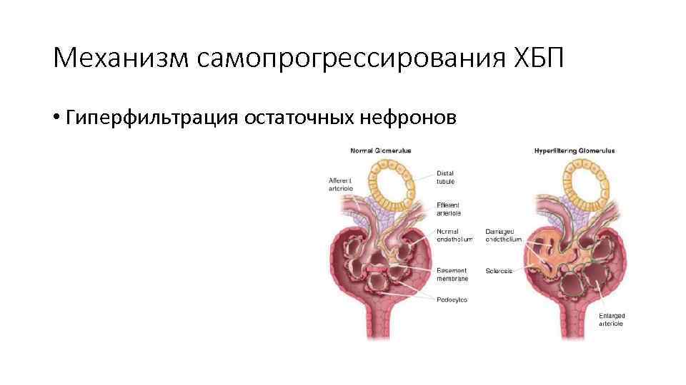 Механизм самопрогрессирования ХБП • Гиперфильтрация остаточных нефронов 