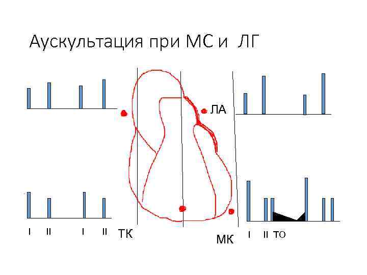 Аускультация при МС и ЛГ ЛА I II ТК МК I II ТО 