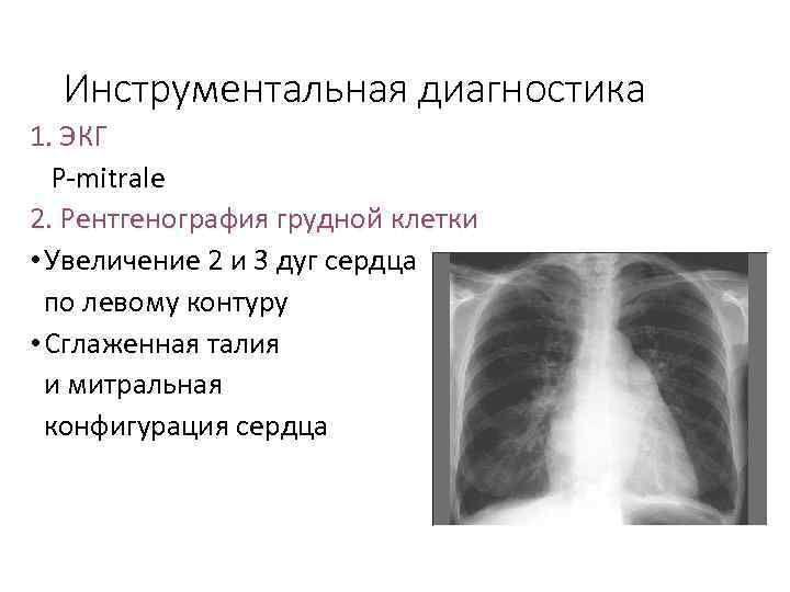 Инструментальная диагностика 1. ЭКГ Р-mitrale 2. Рентгенография грудной клетки • Увеличение 2 и 3