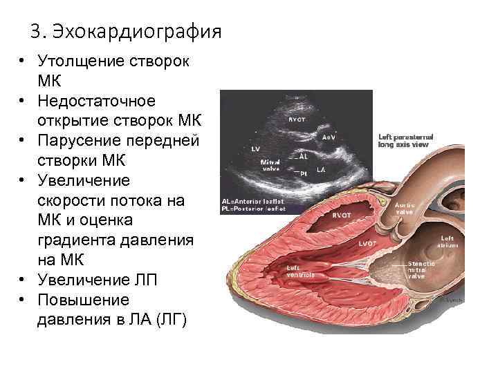 3. Эхокардиография • Утолщение створок МК • Недостаточное открытие створок МК • Парусение передней