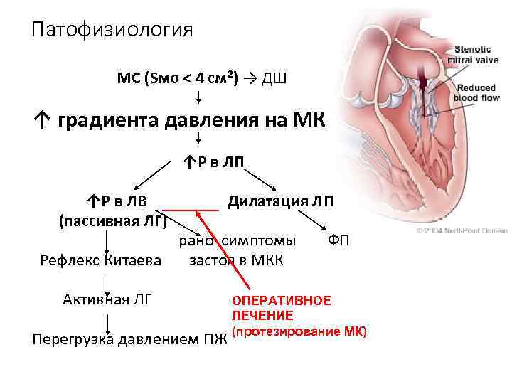 Патофизиология МС (Sмо < 4 см²) → ДШ ↑ градиента давления на МК ↑Р