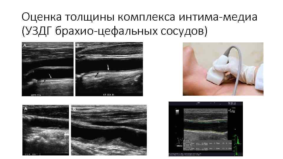 Оценка толщины комплекса интима-медиа (УЗДГ брахио-цефальных сосудов) 