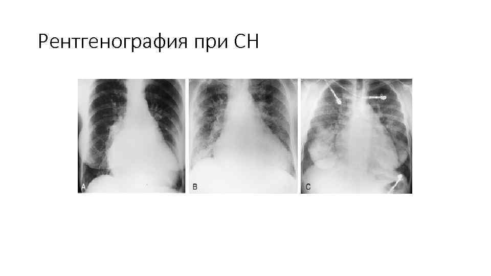 Рентгенография при СН 