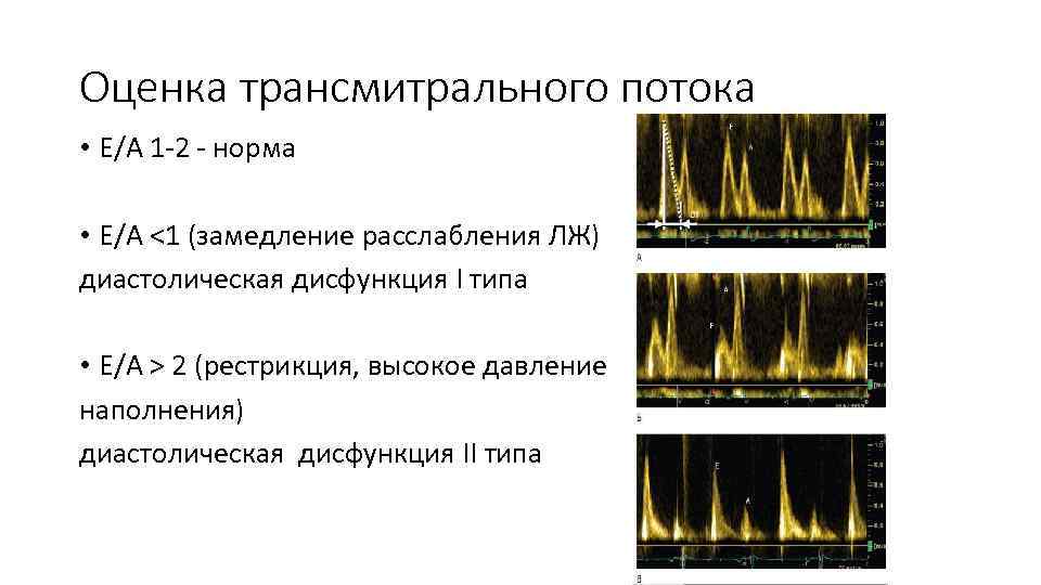 Оценка трансмитрального потока • Е/A 1 -2 - норма • Е/A <1 (замедление расслабления