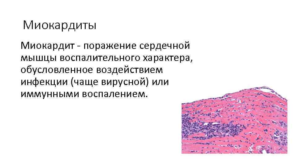 Миокардиты Миокардит - поражение сердечной мышцы воспалительного характера, обусловленное воздействием инфекции (чаще вирусной) или