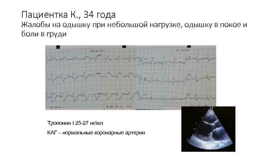 Пациентка К. , 34 года Жалобы на одышку при небольшой нагрузке, одышку в покое