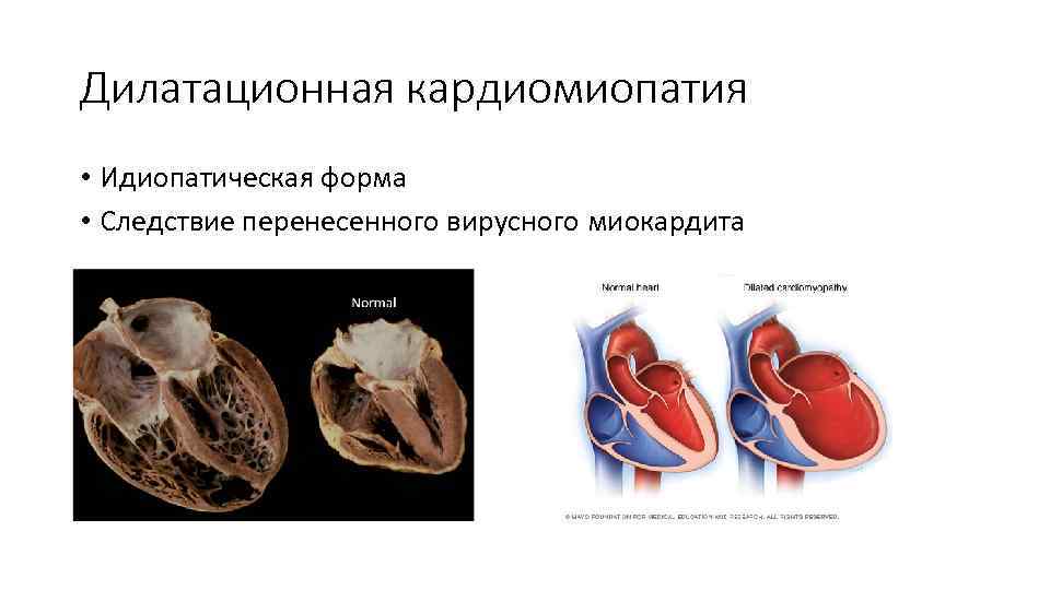 Дилатационная кардиомиопатия • Идиопатическая форма • Следствие перенесенного вирусного миокардита 