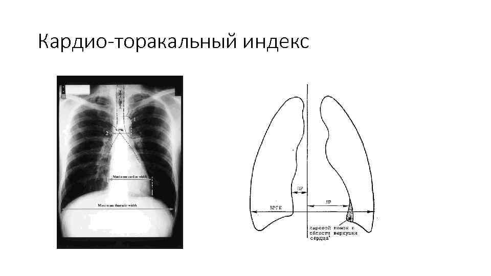 Кардио-торакальный индекс 