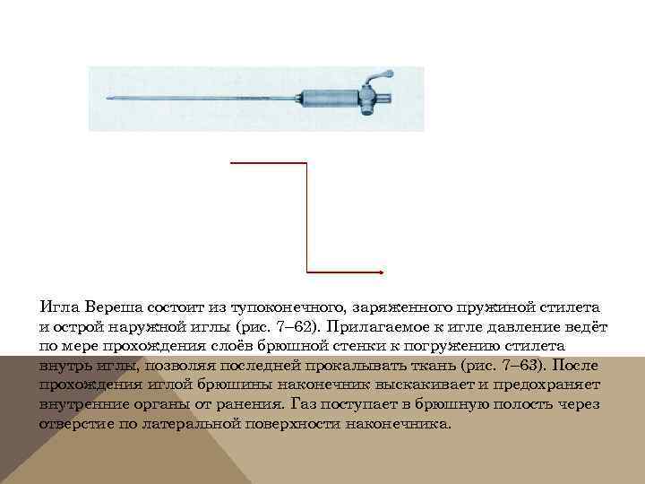 Игла Вереша состоит из тупоконечного, заряженного пружиной стилета и острой наружной иглы (рис. 7–