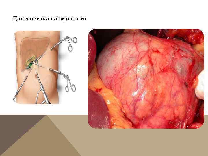 Диагностика панкреатита 