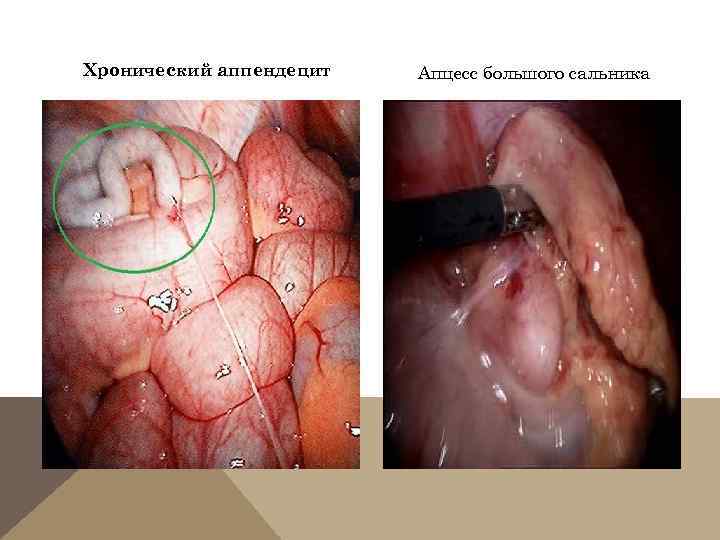 Хронический аппендецит Апцесс большого сальника 