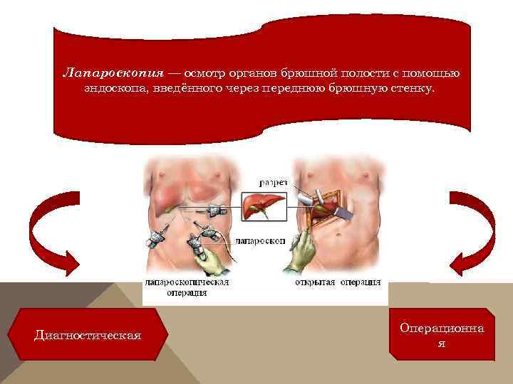 Лапароскопия — осмотр органов брюшной полости с помощью эндоскопа, введённого через переднюю брюшную стенку.