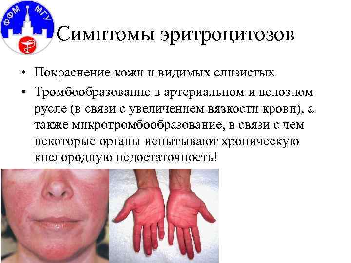 Симптомы эритроцитозов • Покраснение кожи и видимых слизистых • Тромбообразование в артериальном и венозном