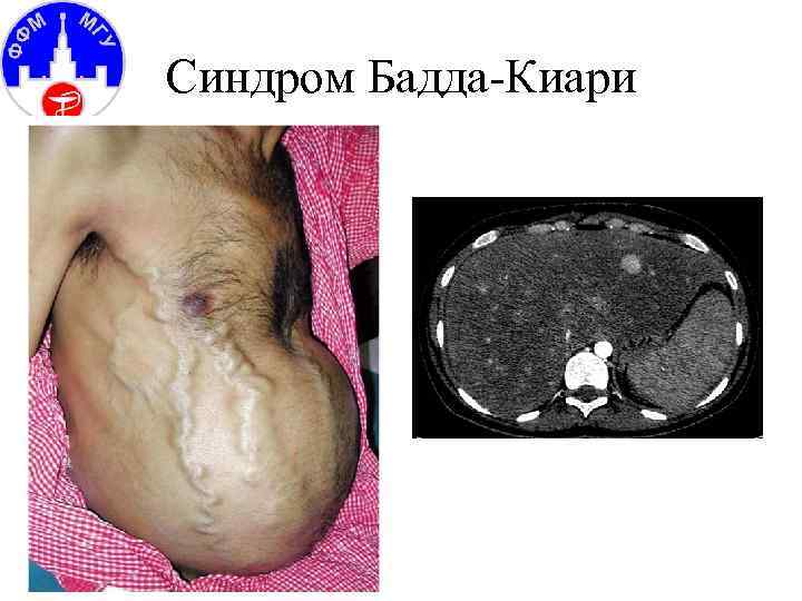 Синдром Бадда-Киари 