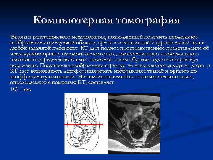 Компьютерная томография Вариант рентгеновского исследования, позволяющий получить продольное изображение исследуемой области, срезы в сагиттальной