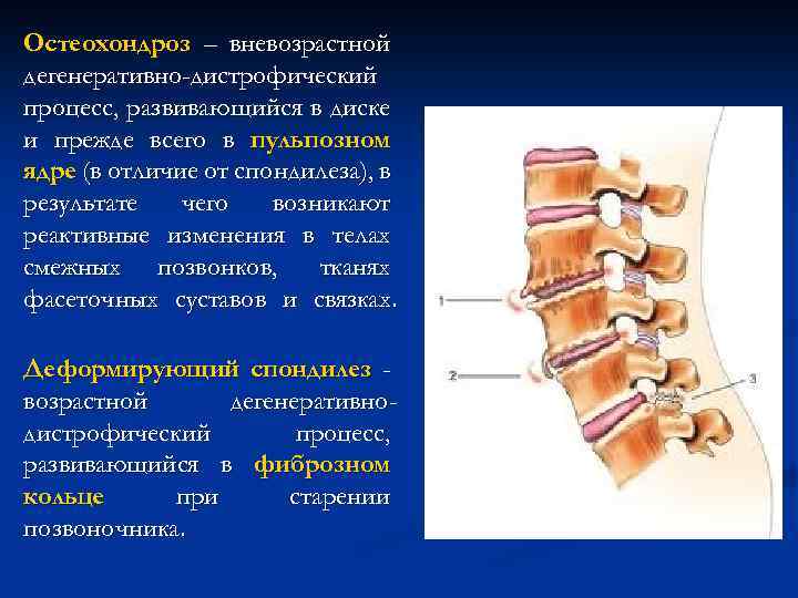 Спондилез поясничного отдела позвоночника что. Спондилоартроз спондилез остеохондроз. Спондилез презентация. Спондилоартроз и спондилез разница. Спондилез позвоночника дегенеративно-дистрофическое изменение.