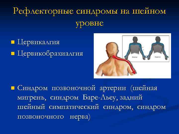 Рефлекторные боли. Синдром цервикалгии шейный отдел. Шейный рефлекторный синдром. Цервикобрахиалгия цервикалгия. Рефлекторный синдром на шейном уровне это.