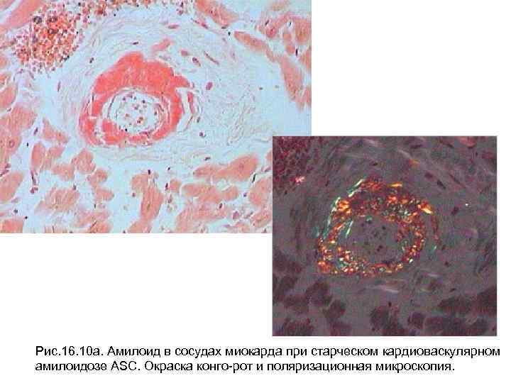 Рис. 16. 10 а. Амилоид в сосудах миокарда при старческом кардиоваскулярном амилоидозе ASC. Окраска