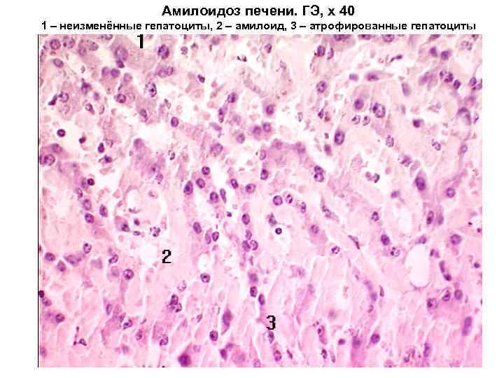 Амилоидоз печени. ГЭ, х 40 1 – неизменённые гепатоциты, 2 – амилоид, 3 –