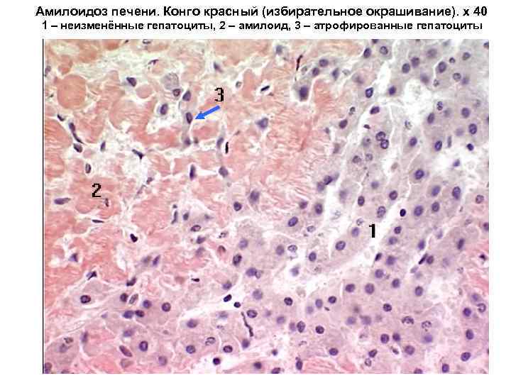 Амилоидоз печени. Конго красный (избирательное окрашивание). х 40 1 – неизменённые гепатоциты, 2 –