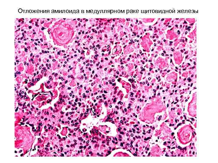 Отложения амилоида в медуллярном раке щитовидной железы 
