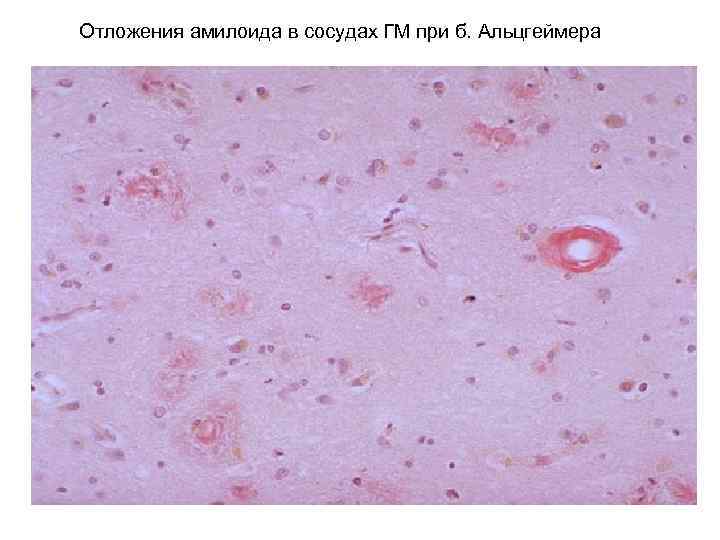 Отложения амилоида в сосудах ГМ при б. Альцгеймера 
