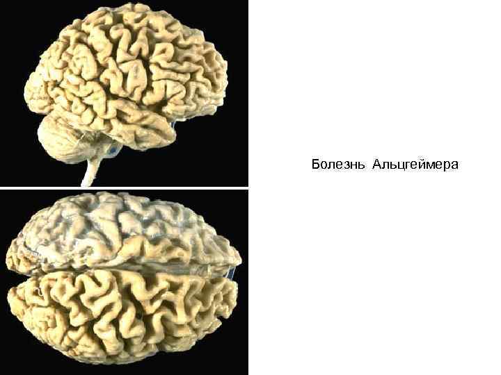 Болезнь Альцгеймера 