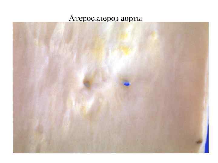 Атеросклероз аорты 