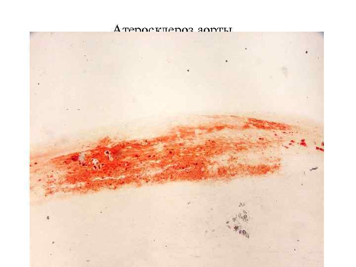 Атеросклероз аорты 