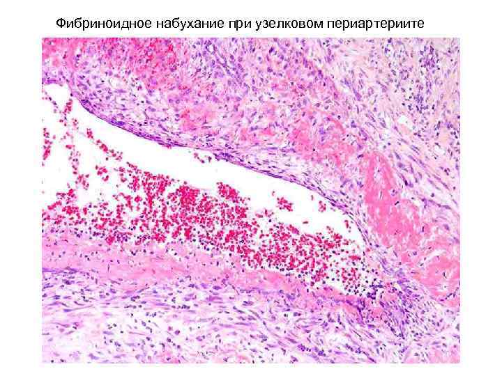 Фибриноидное набухание при узелковом периартериите 