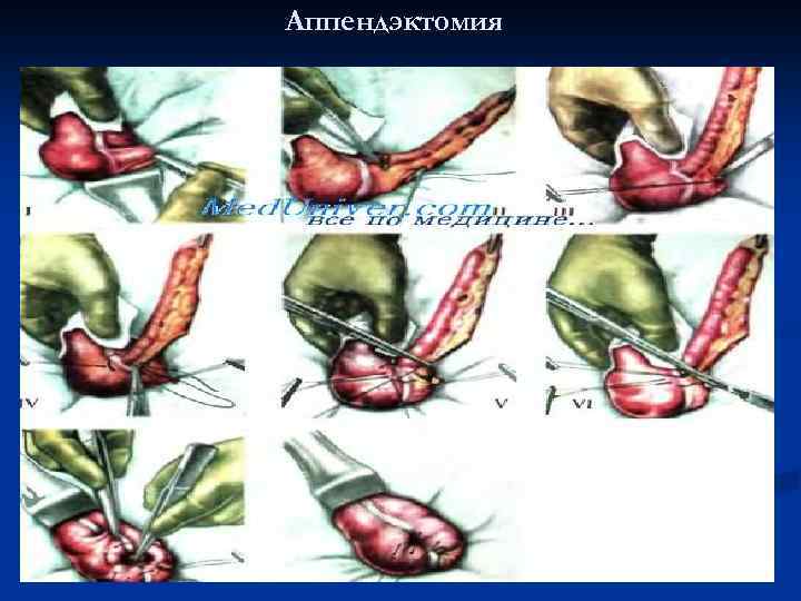 Аппендэктомия 