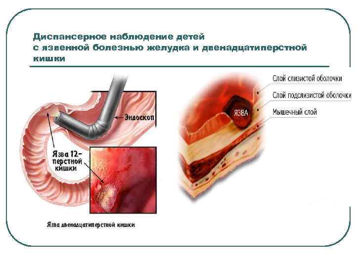 Диспансерное наблюдение детей с язвенной болезнью желудка и двенадцатиперстной кишки 