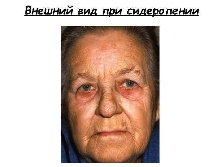 Внешний вид при сидеропении 