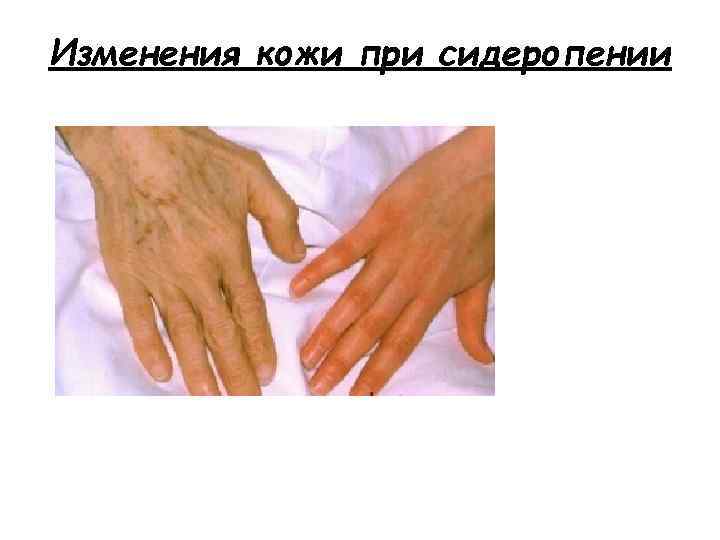 Изменения кожи при сидеропении 