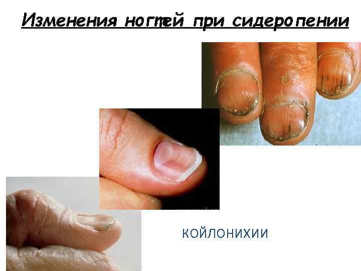Изменения ногтей при сидеропении КОЙЛОНИХИИ 