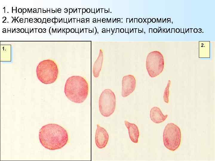 1. Нормальные эритроциты. 2. Железодефицитная анемия: гипохромия, анизоцитоз (микроциты), анулоциты, пойкилоцитоз. 1. 2. 