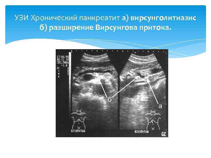 УЗИ Хронический панкреатит а) вирсунголитиазис б) разширение Вирсунгова притока. 