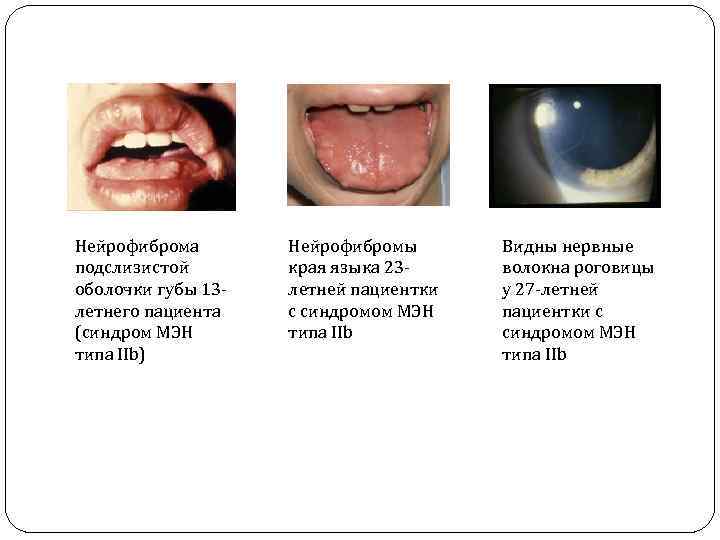 Нейрофиброма подслизистой оболочки губы 13 летнего пациента (синдром МЭН типа IIb) Нейрофибромы края языка